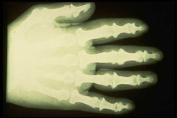 Acromegaly or Gigantism